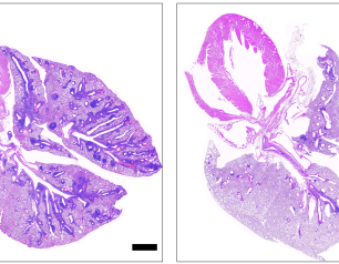 Two pink- and purple-speckled, lobe-shaped lung cross-sections in black-bordered boxes with white backgrounds, the left one with several dark purple regions in the cross-section.