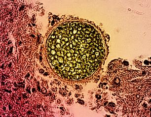 A round Coccidioides fungal spherule (colorized yellow) found in a tissue sample (colorized pink). It is round and contains many smaller round dots.